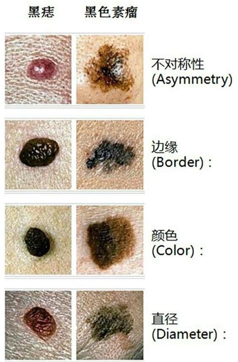 有毛的痣|黑痣、红痣、长毛的痣，哪种痣容易出现癌变？